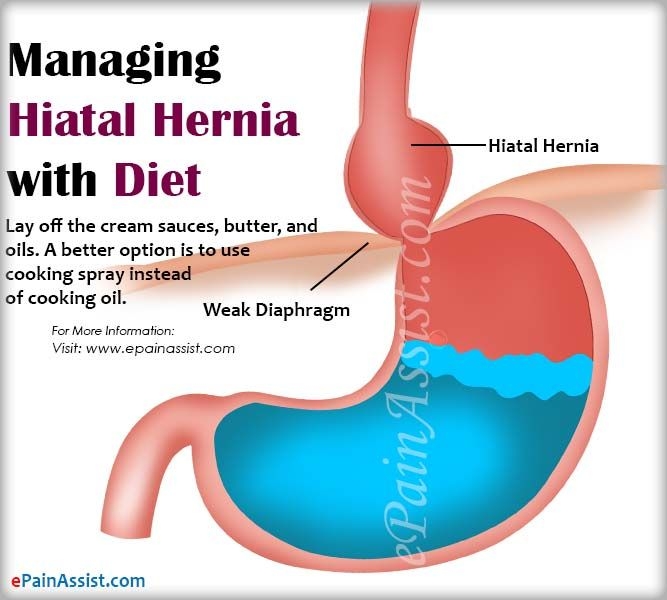 Managing Hiatal Hernia With Diet Hiatal Hernia Diet H Vrogue co