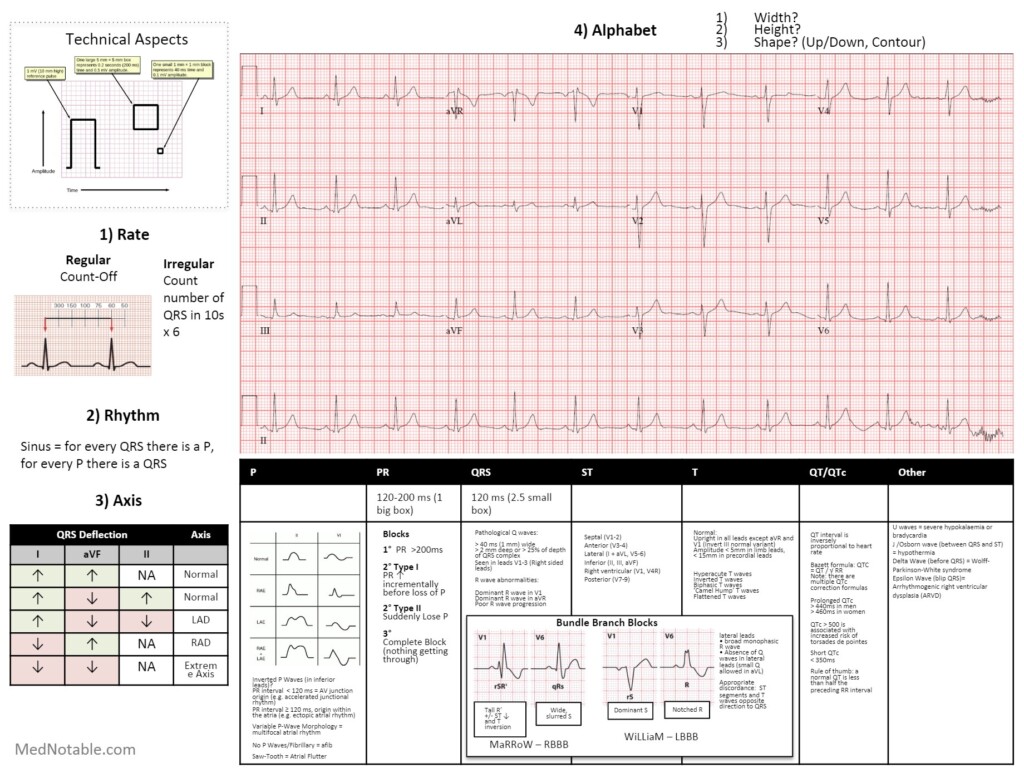 Printable 12 Lead Ekg Interpretation Cheat Sheet